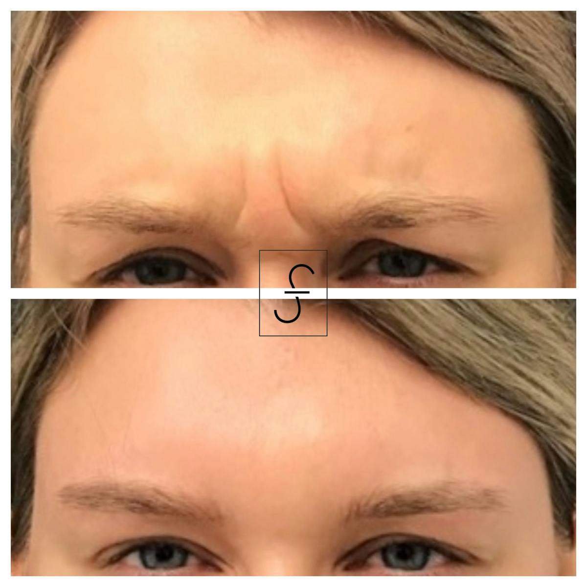 BOTOX Before & After Gallery - Patient 252298 - Image 2