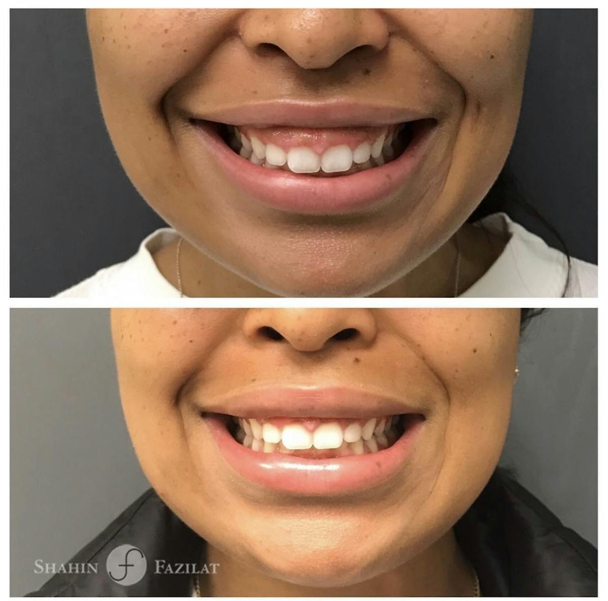 BOTOX Before & After Gallery - Patient 300678 - Image 1