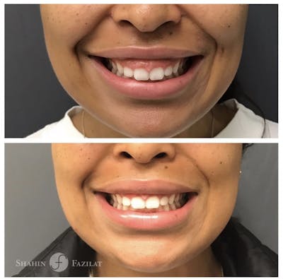BOTOX Before & After Gallery - Patient 300678 - Image 1