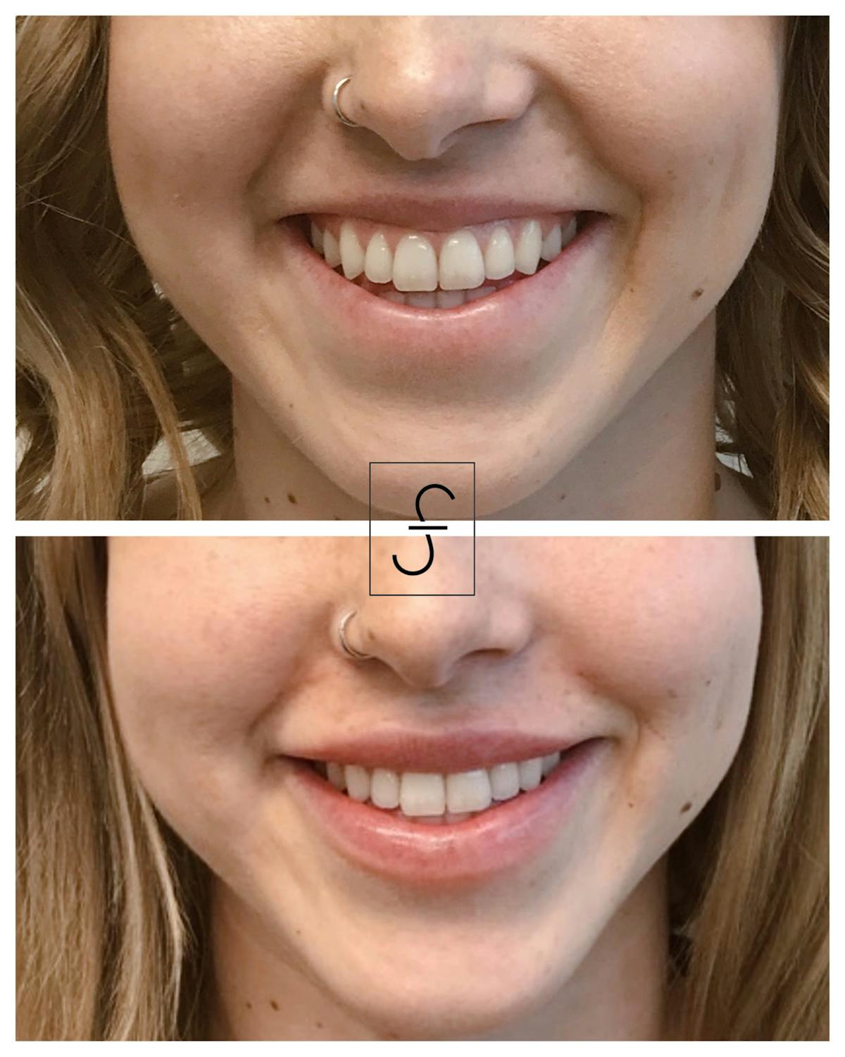 BOTOX Before & After Gallery - Patient 374566 - Image 1