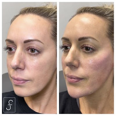 Juvederm Before & After Gallery - Patient 326731 - Image 1