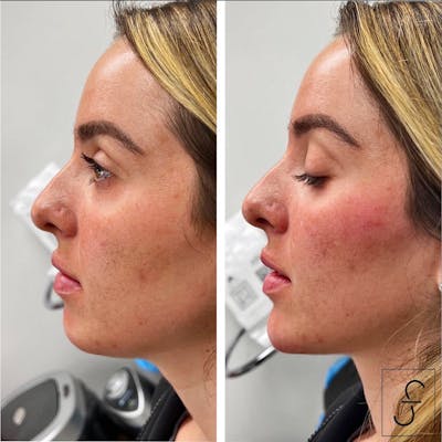 Juvederm Before & After Gallery - Patient 197273 - Image 1
