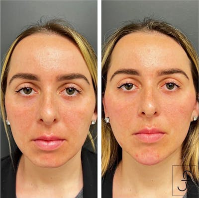 Juvederm Before & After Gallery - Patient 225473 - Image 1