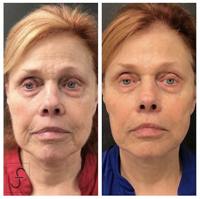 Juvederm Before & After Gallery - Patient 248980 - Image 1