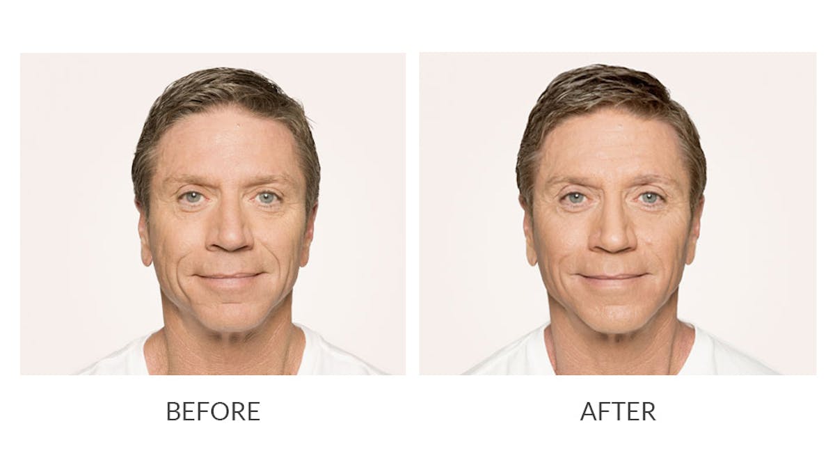 Radiesse Before & After Gallery - Patient 102432 - Image 1