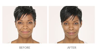 Radiesse Before & After Gallery - Patient 268444 - Image 1