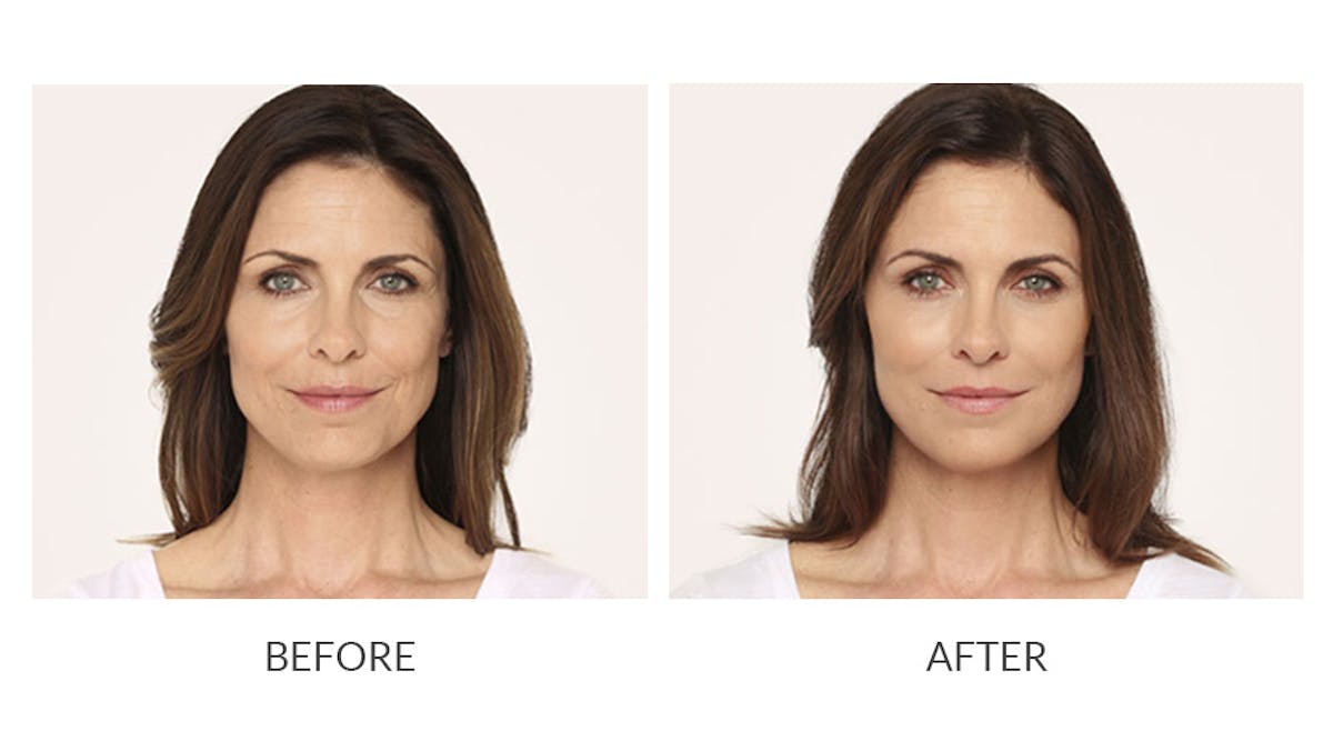Radiesse Before & After Gallery - Patient 330606 - Image 1