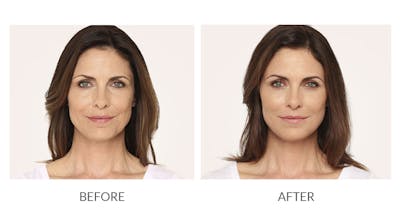 Radiesse Before & After Gallery - Patient 330606 - Image 1
