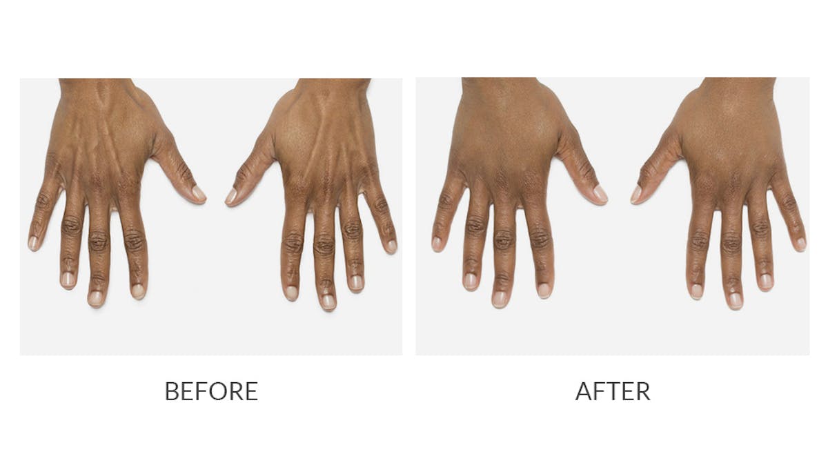 Radiesse Before & After Gallery - Patient 309709 - Image 1