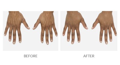Radiesse Before & After Gallery - Patient 309709 - Image 1