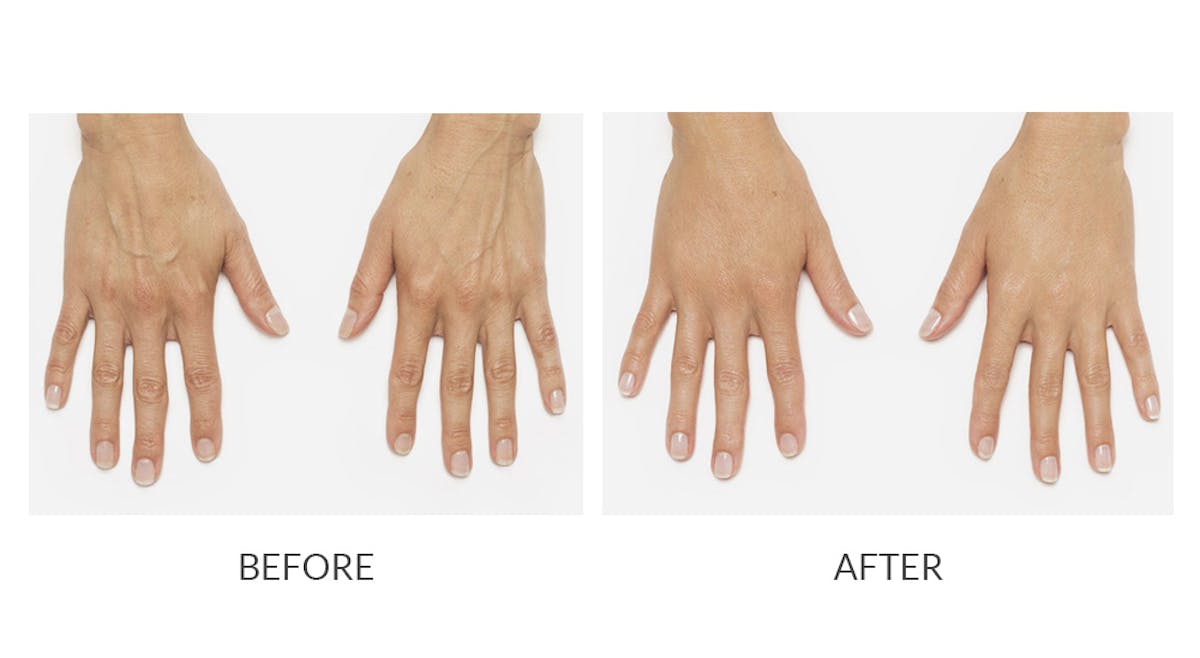 Radiesse Before & After Gallery - Patient 174338 - Image 1