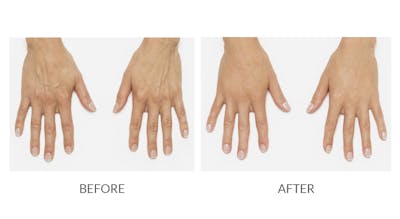 Radiesse Before & After Gallery - Patient 174338 - Image 1