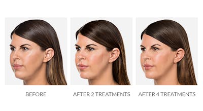 Kybella Before & After Gallery - Patient 234123 - Image 1