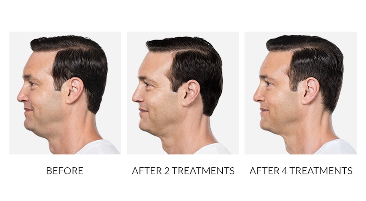 Kybella Before & After Gallery - Patient 360404 - Image 1