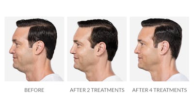 Kybella Before & After Gallery - Patient 360404 - Image 1
