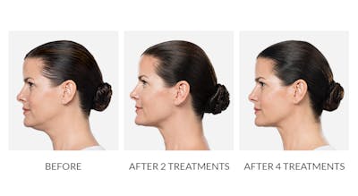 Kybella Before & After Gallery - Patient 384618 - Image 1