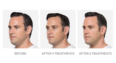 Kybella Before & After Gallery - Patient 784052 - Image 1