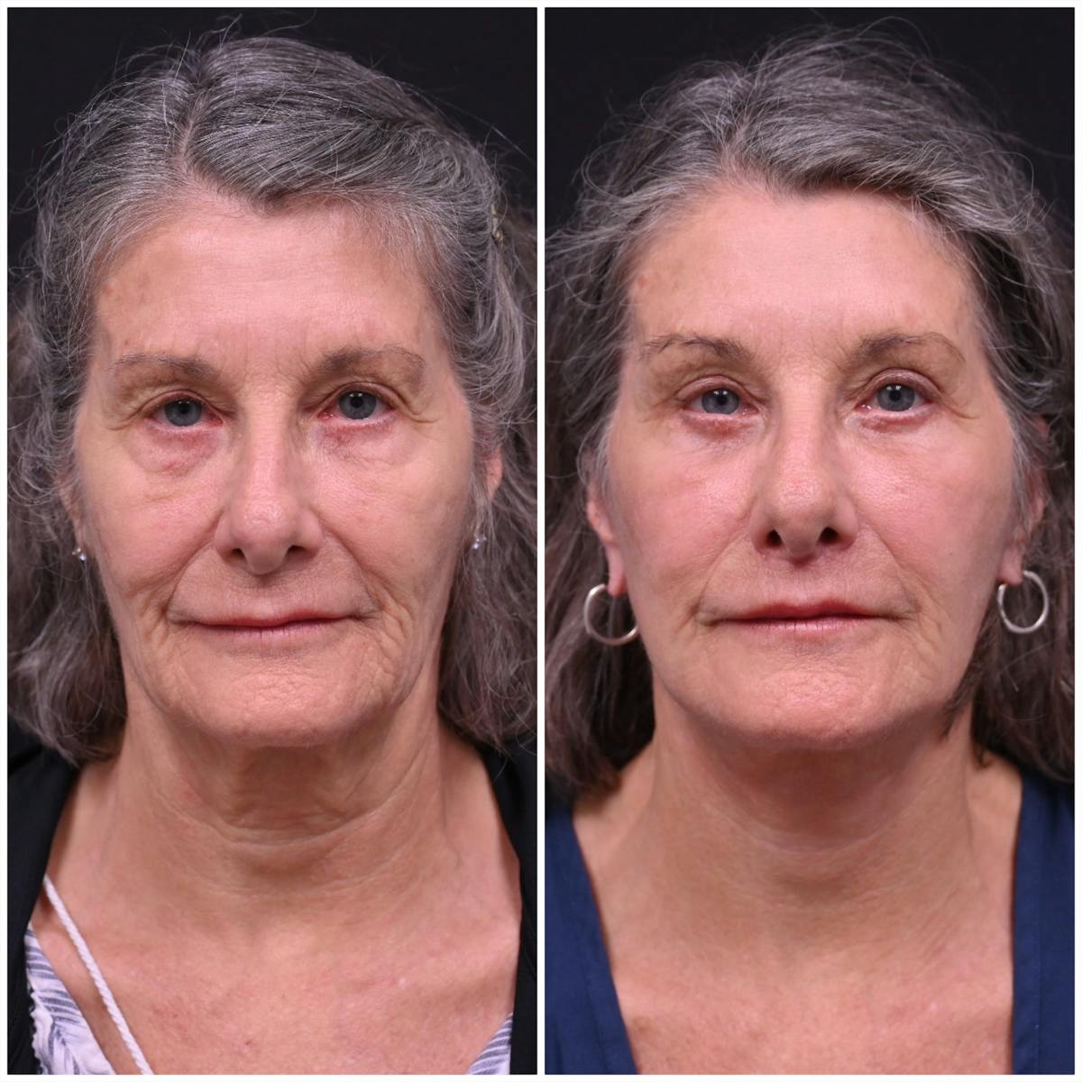 Face/Neck Lift Before & After Gallery - Patient 396917 - Image 1