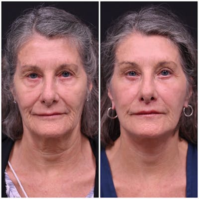 Face/Neck Lift Before & After Gallery - Patient 396917 - Image 1