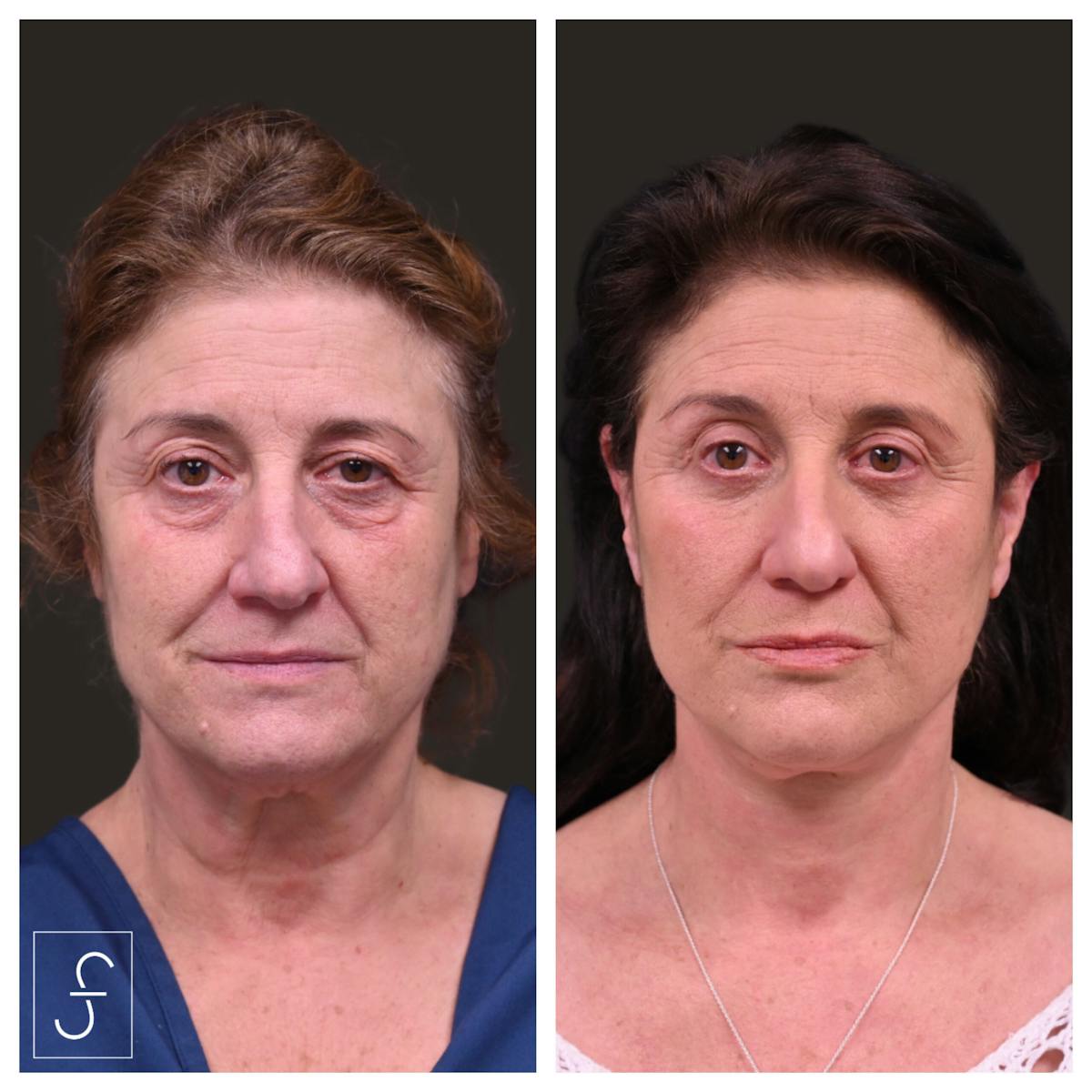 Face/Neck Lift Before & After Gallery - Patient 418637 - Image 1