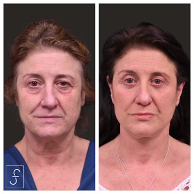 Face/Neck Lift Before & After Gallery - Patient 418637 - Image 1