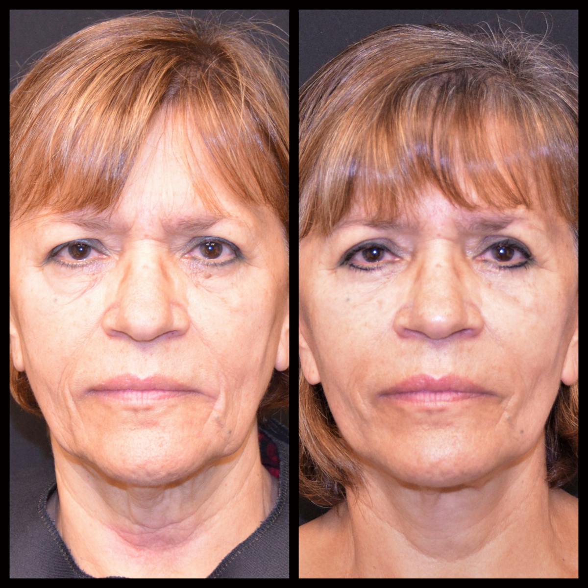 Face/Neck Lift Before & After Gallery - Patient 232940 - Image 1