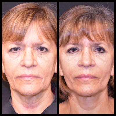 Face/Neck Lift Before & After Gallery - Patient 232940 - Image 1