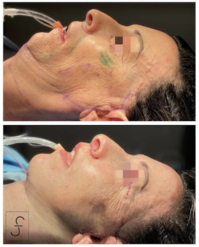 Face/Neck Lift Before & After Gallery - Patient 267300 - Image 1