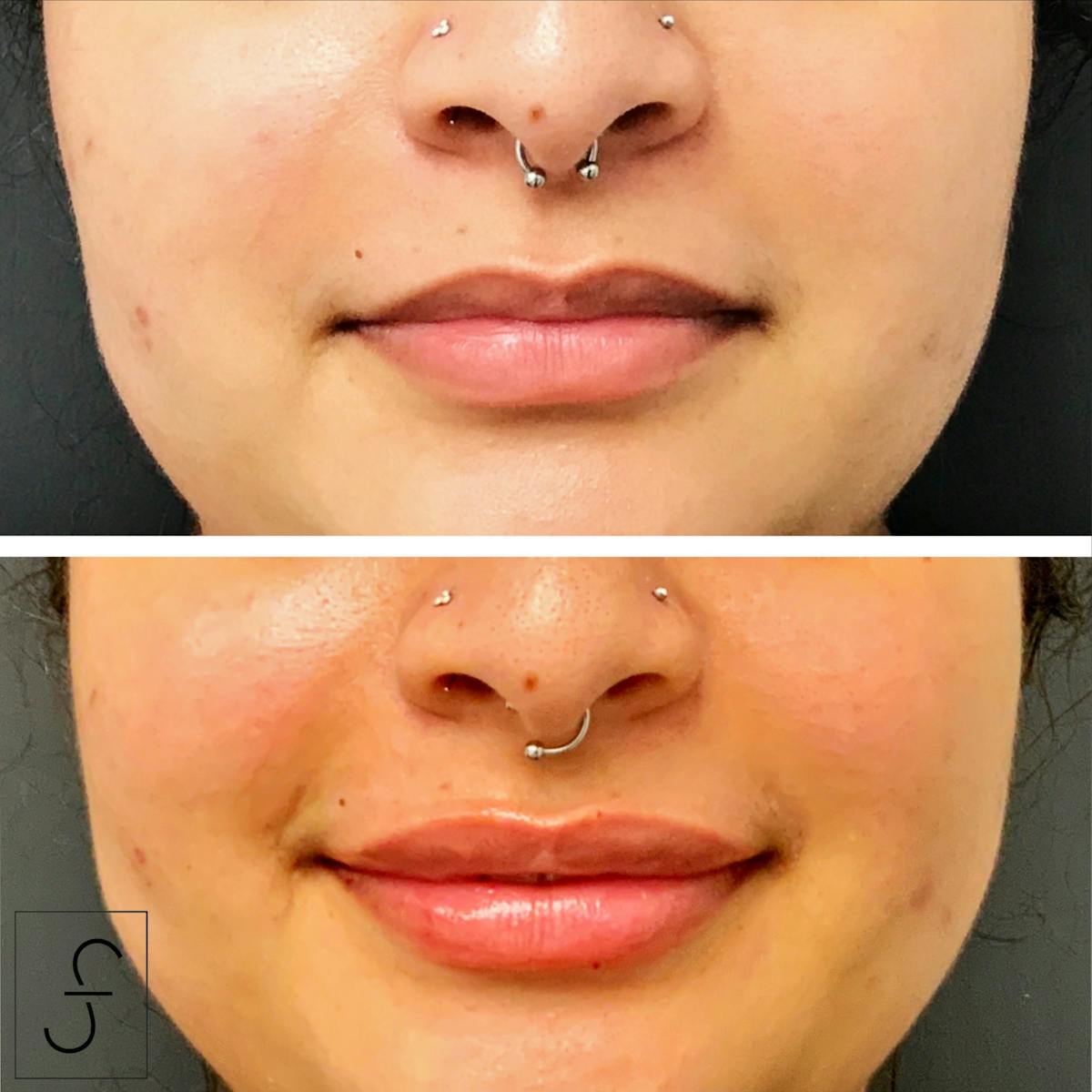 Lip Filler Before & After Gallery - Patient 418154 - Image 1