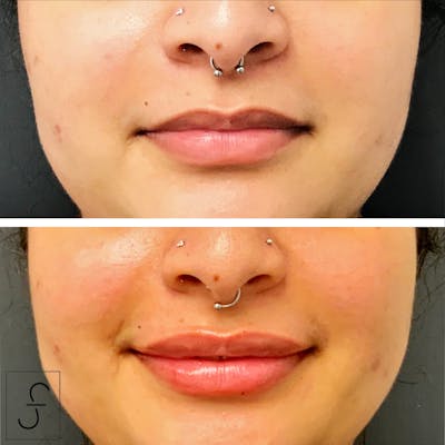 Lip Filler Before & After Gallery - Patient 418154 - Image 1