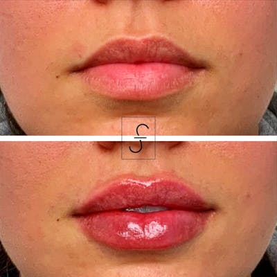 Lip Filler Before & After Gallery - Patient 345242 - Image 1