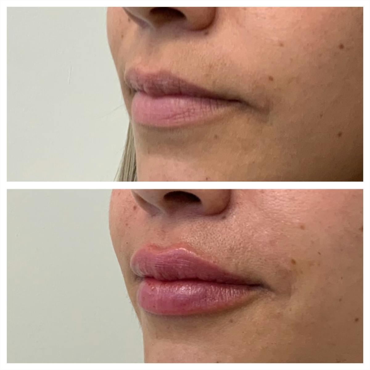 Lip Filler Before & After Gallery - Patient 158963 - Image 1