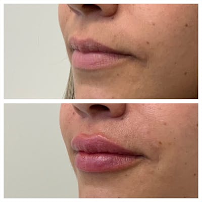 Lip Filler Before & After Gallery - Patient 158963 - Image 1