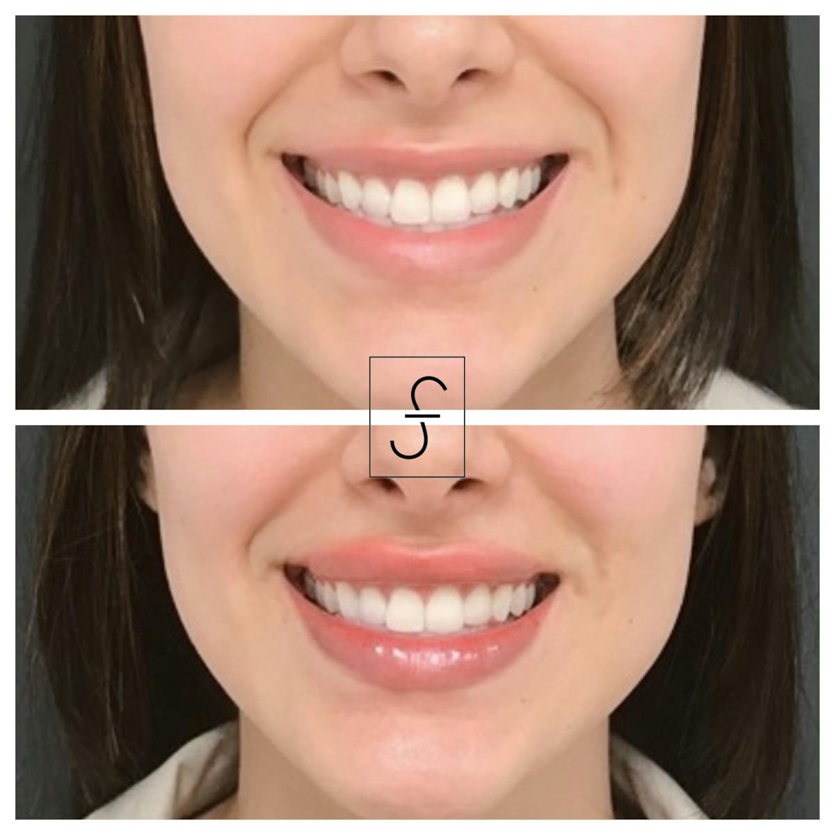 Lip Filler Before & After Gallery - Patient 231895 - Image 1
