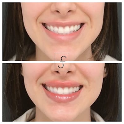 Lip Filler Before & After Gallery - Patient 231895 - Image 1