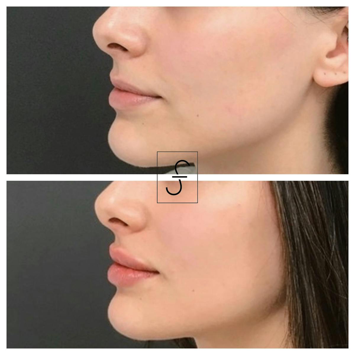 Lip Filler Before & After Gallery - Patient 231895 - Image 2