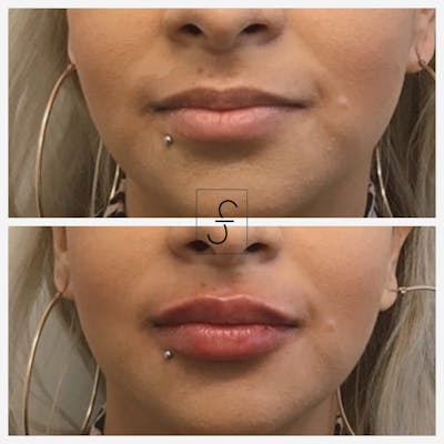 Lip Filler Before & After Gallery - Patient 207375 - Image 1