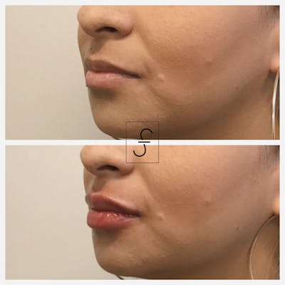 Lip Filler Before & After Gallery - Patient 169101 - Image 1
