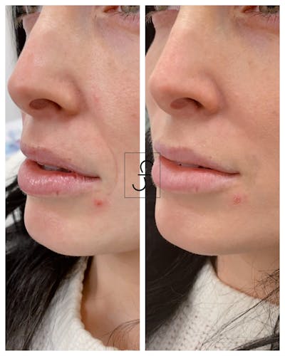 Lip Filler Before & After Gallery - Patient 314717 - Image 1