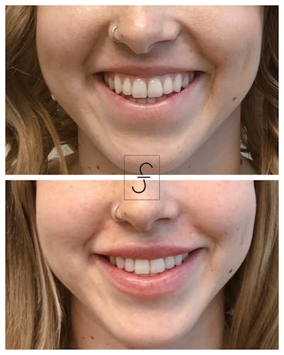 Lip Filler Before & After Gallery - Patient 195710 - Image 1