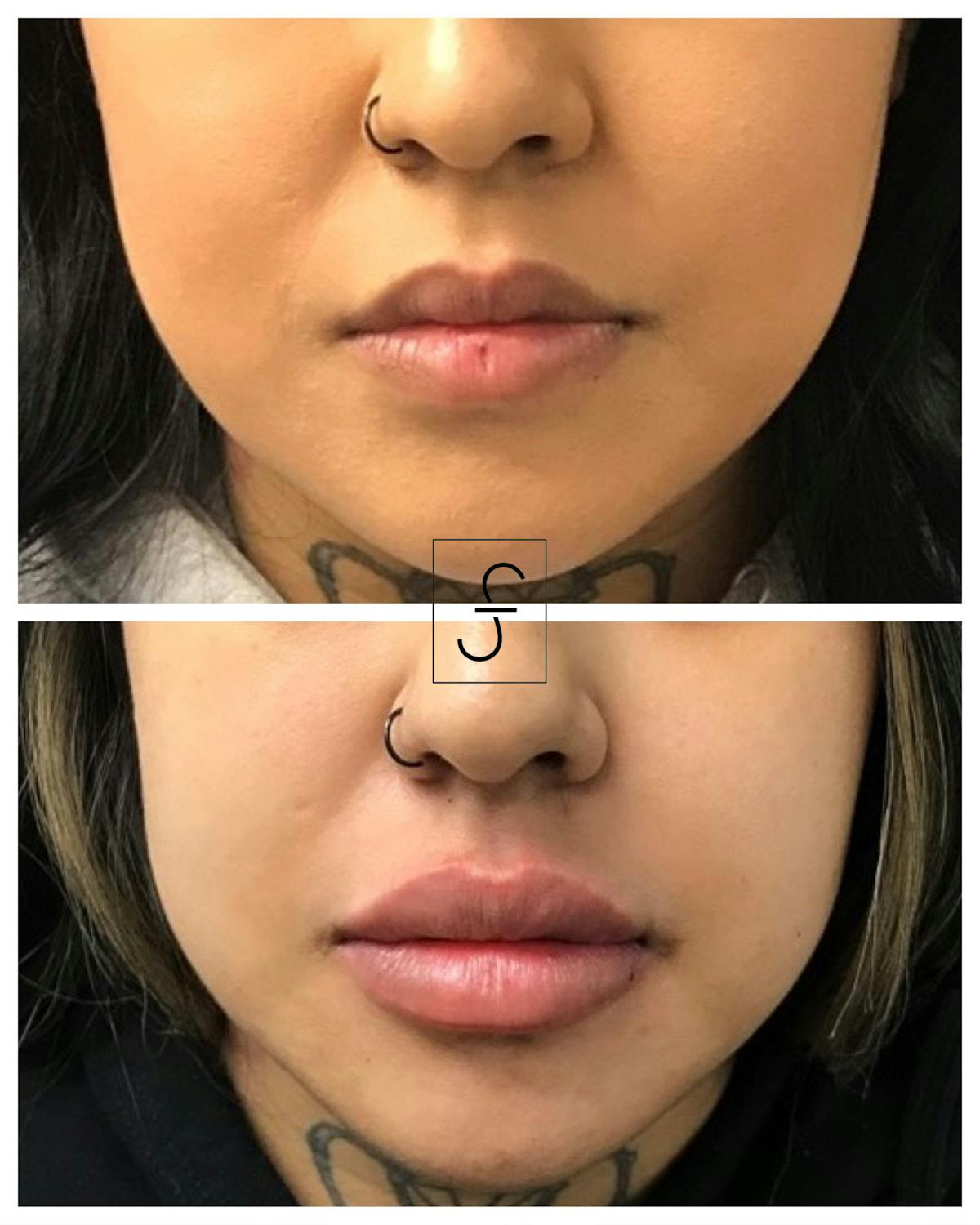 Lip Filler Before & After Gallery - Patient 230054 - Image 1