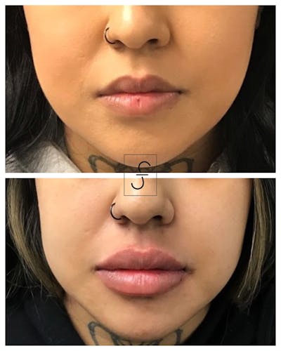 Lip Filler Before & After Gallery - Patient 230054 - Image 1