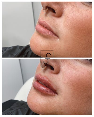 Lip Filler Before & After Gallery - Patient 295759 - Image 1