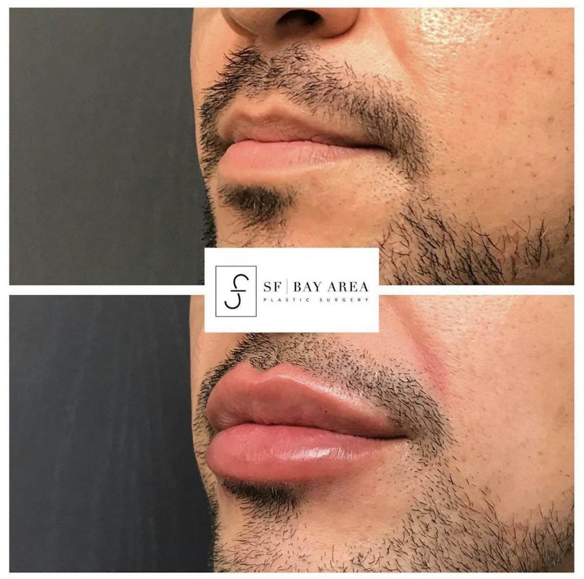 Lip Filler Before & After Gallery - Patient 182654 - Image 2