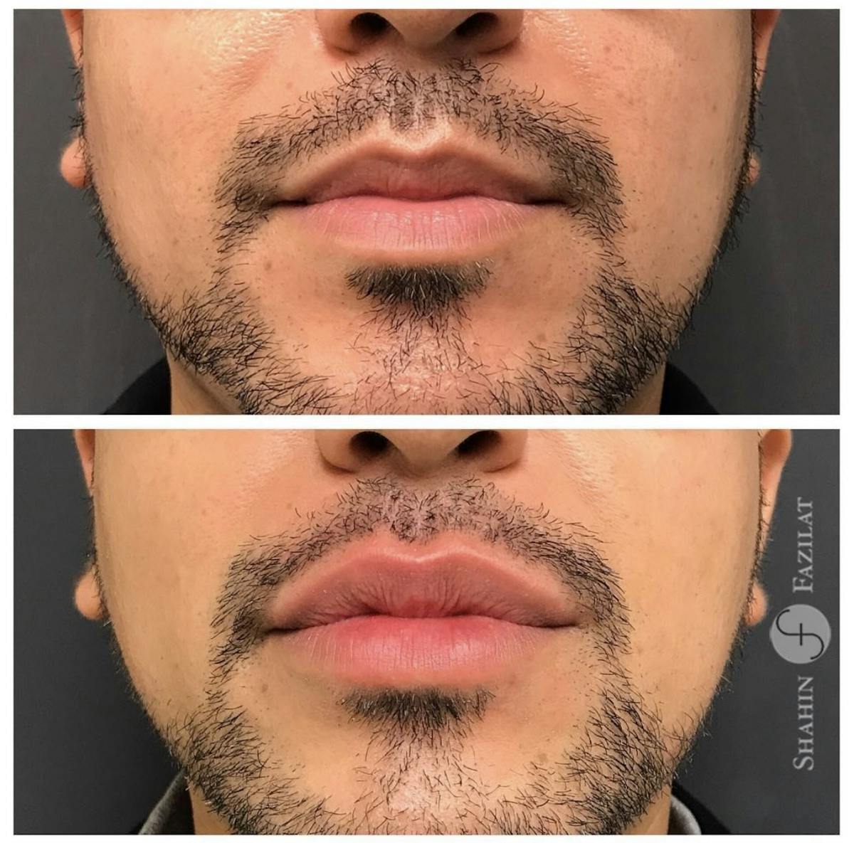 Lip Filler Before & After Gallery - Patient 182654 - Image 1