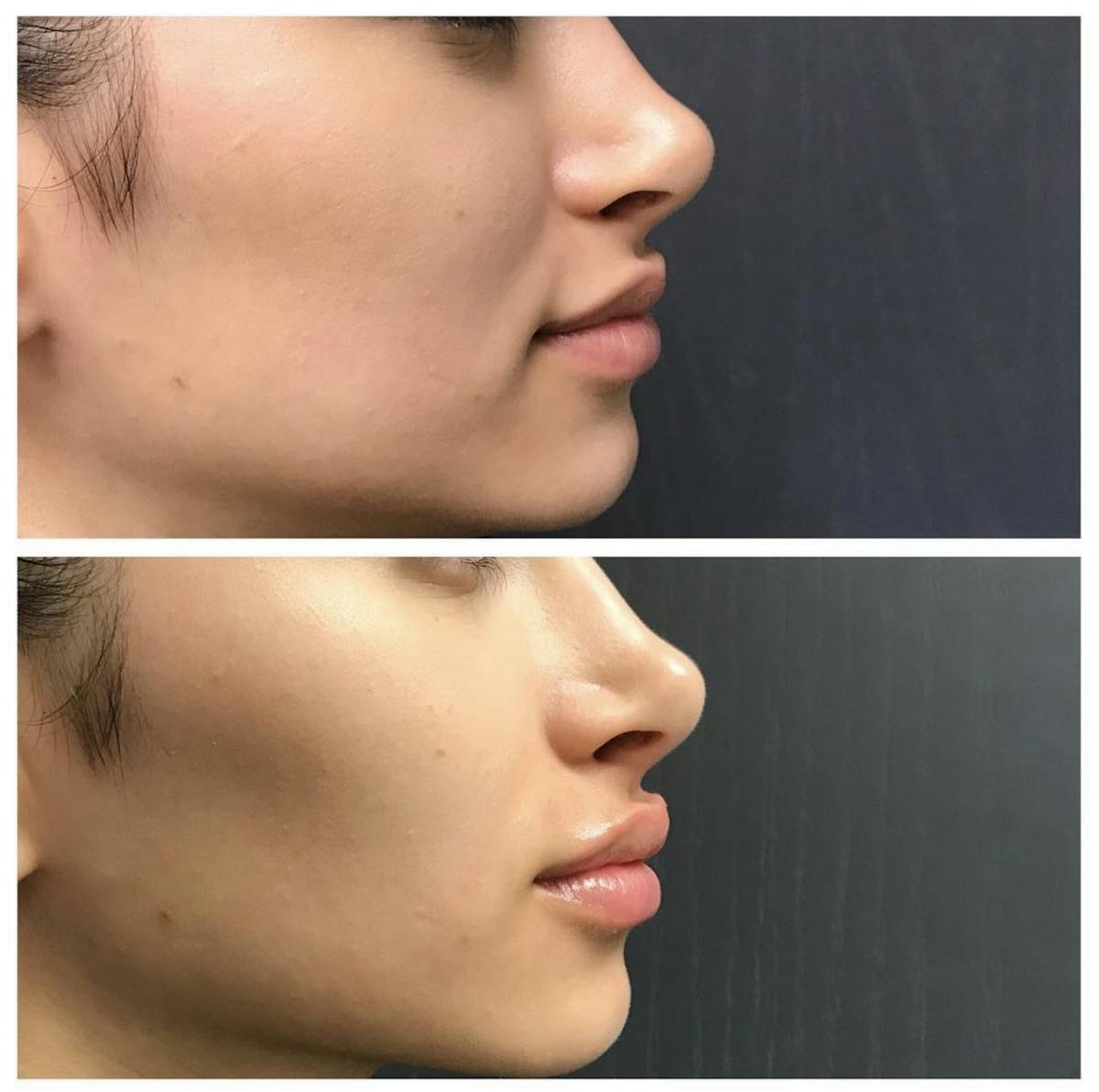 Lip Filler Before & After Gallery - Patient 415052 - Image 1