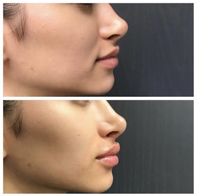Lip Filler Before & After Gallery - Patient 415052 - Image 1