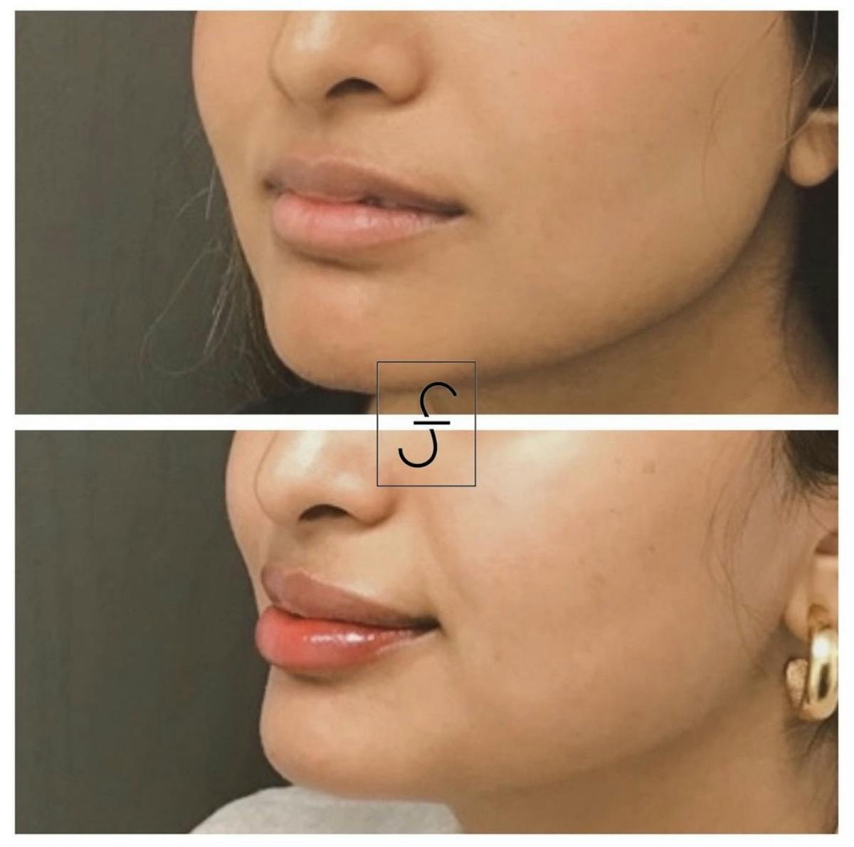 Lip Filler Before & After Gallery - Patient 181738 - Image 1