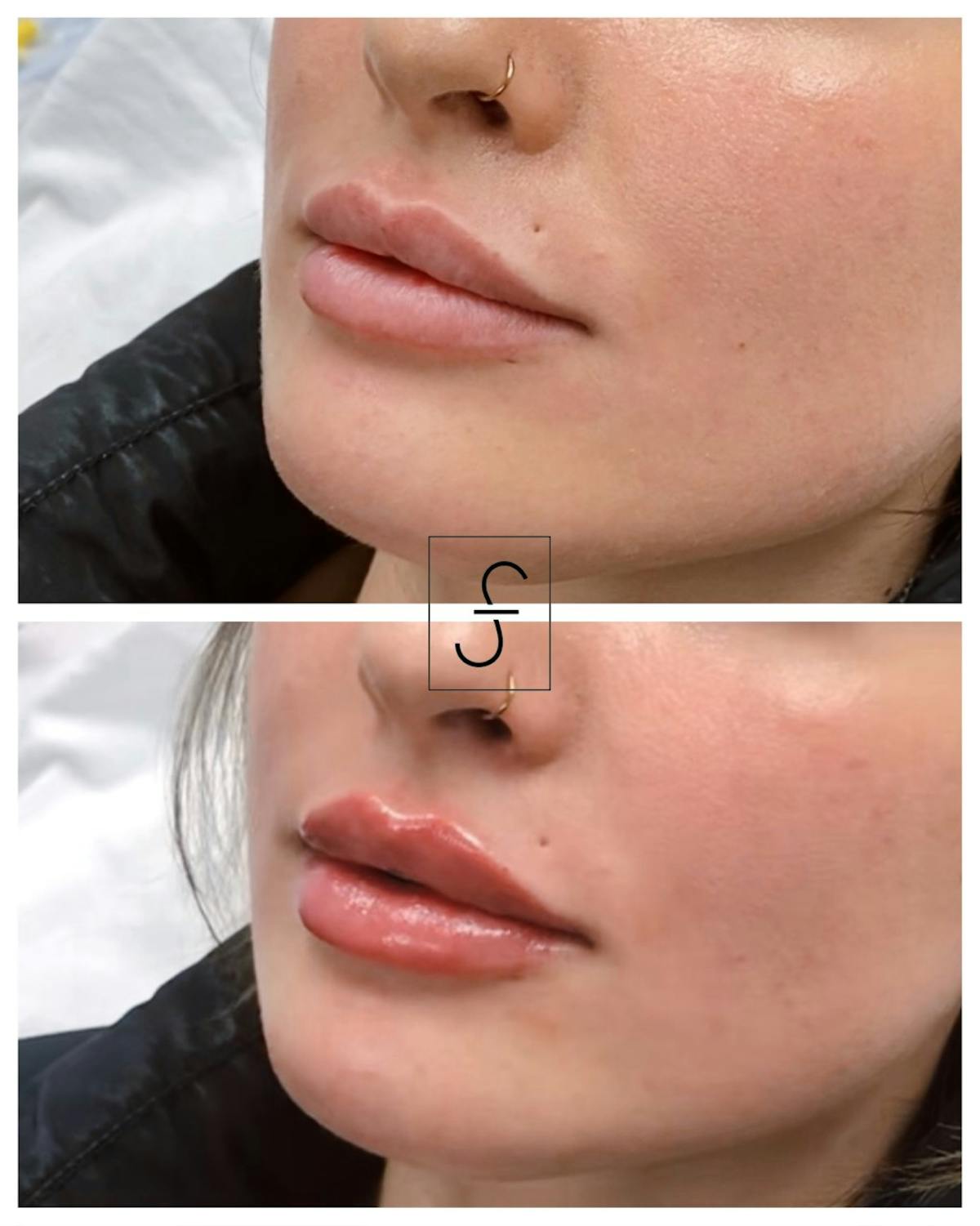 Lip Filler Before & After Gallery - Patient 264875 - Image 1
