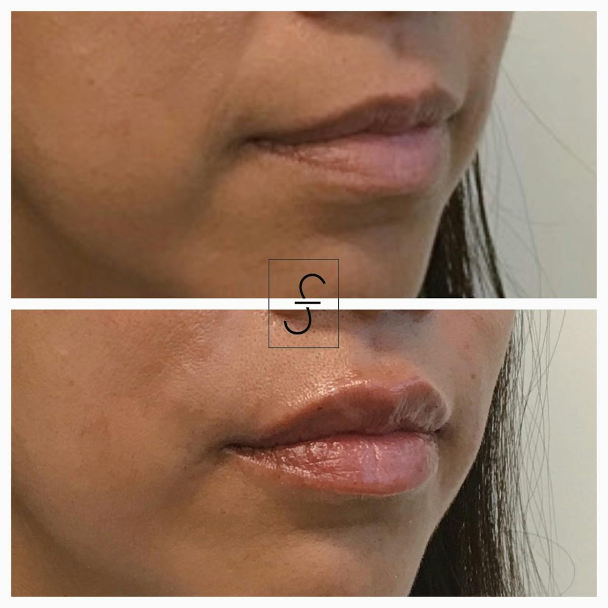 Lip Filler Before & After Gallery - Patient 944108 - Image 2